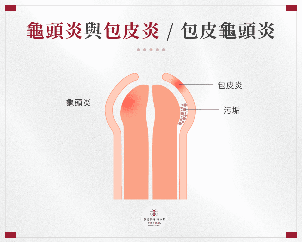 龜頭炎與包皮炎／包皮龜頭炎