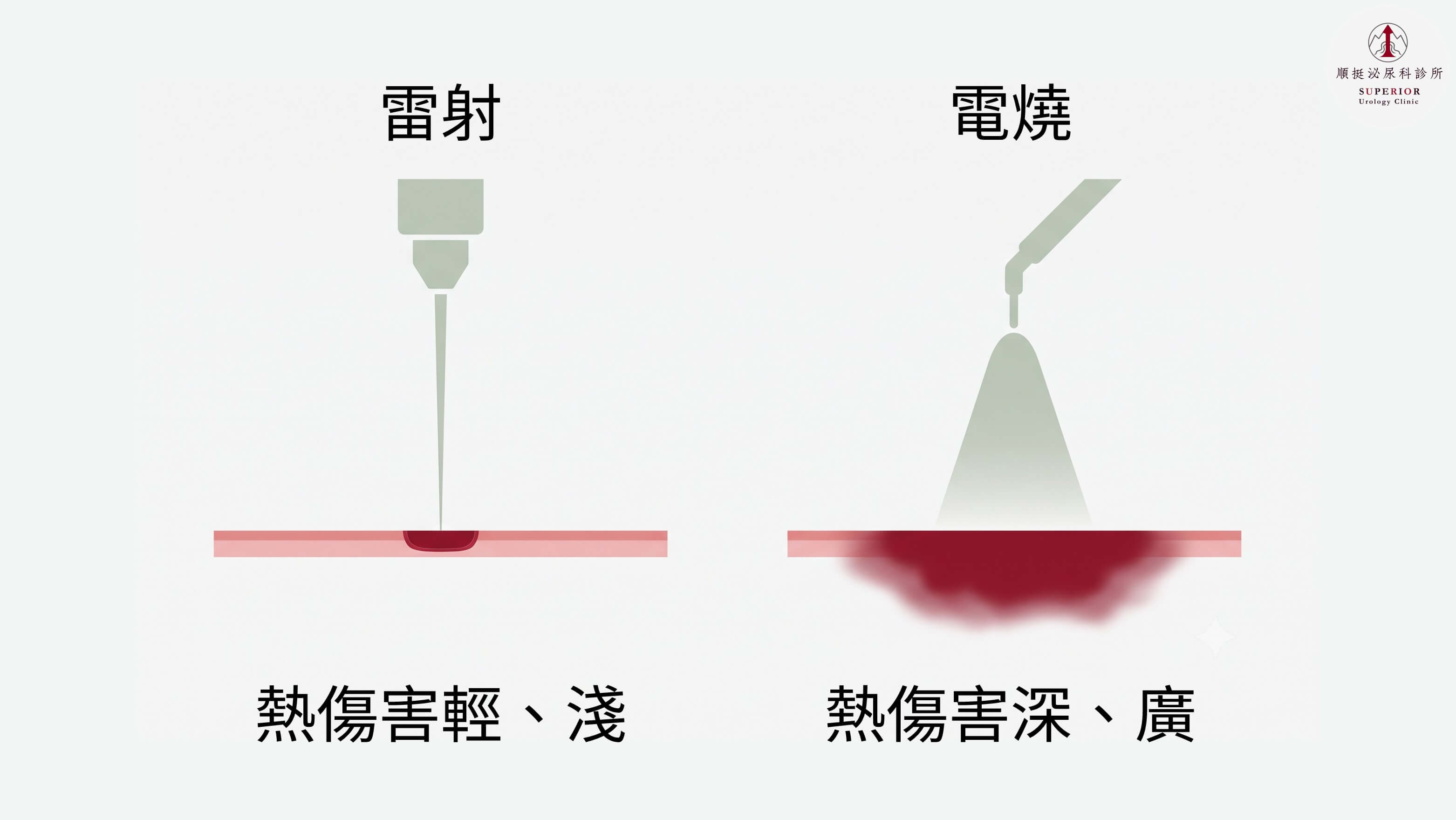 CO2 雷射與傳統電燒熱傷害範圍對比圖